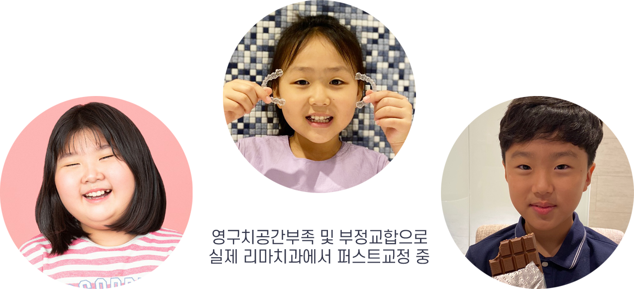 영구치공간부족 및 부정교합으로 실제 리마치과에서 퍼스트교정 중